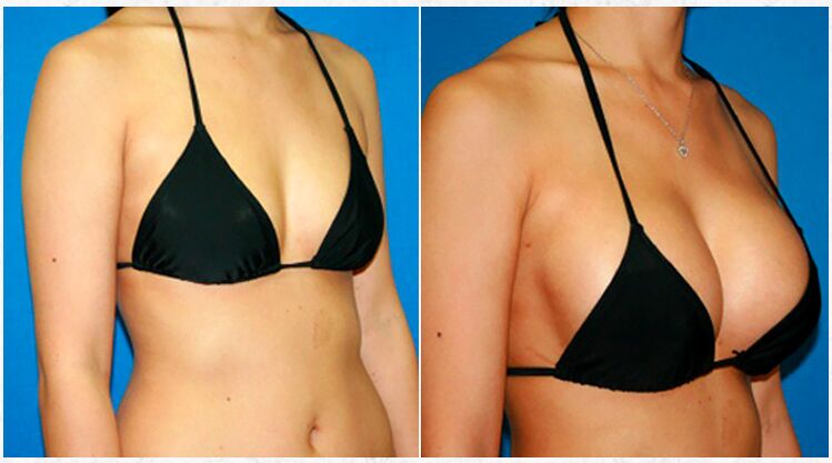 Преди и след пластична операция за уголемяване на гърдите
