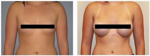 гърди преди и след операция