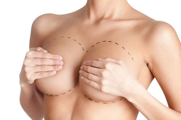 надценка за операция за уголемяване на бюста