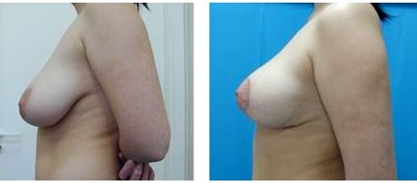 преди и след хирургично уголемяване на гърдите