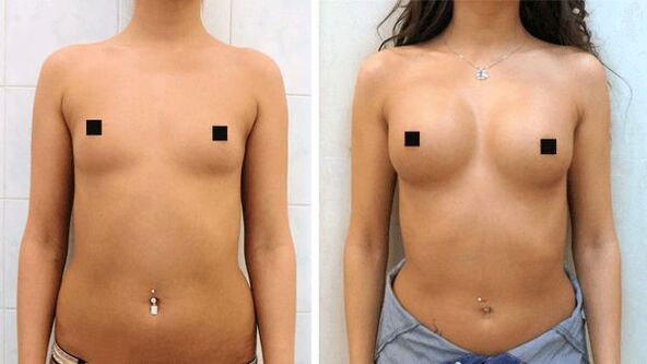 снимки преди и след хирургично уголемяване на бюста